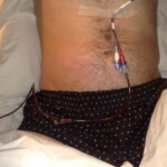 One of many blood transfusion in action.