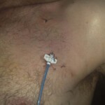 A Groshong line, fully installed.