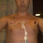 Groshong line is out and the Hickman line is in.