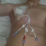 Blood transfusion through the Hickman line..