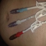 The three pronged Hickman line. Red for blood, blue for chemo and white for antibiotics usually.